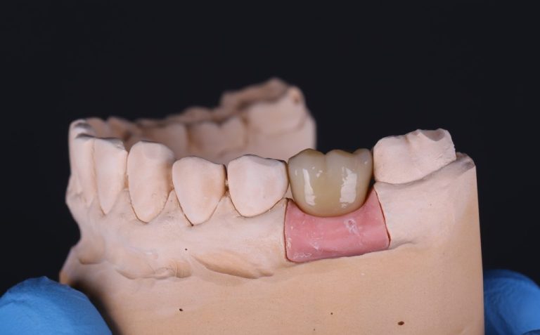 Case study - Implant planning supported with Diagnocat AI