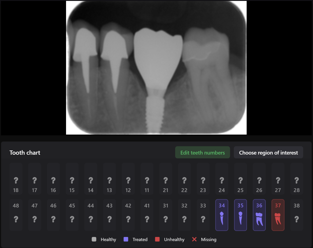 Case study - Implant planning supported with Diagnocat AI 7