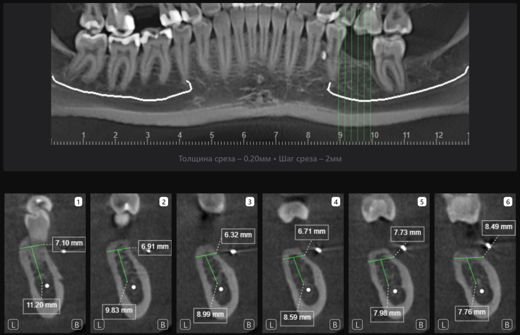 Пример из практики - планирование имплантации в области зуба 3.6 7