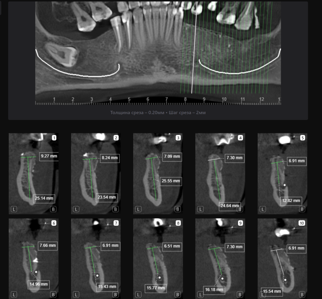 Пример из практики - планирование реконструкции альвеолярного гребня вместе с Diagnocat 9