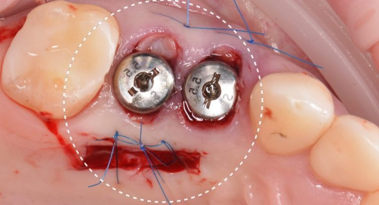 Implant placement using Diagnocat modules