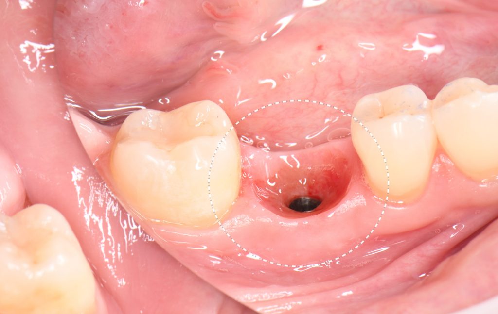 Fallstudie: Implantatplanung für fehlenden Zahn 36 (Universal 19) 11