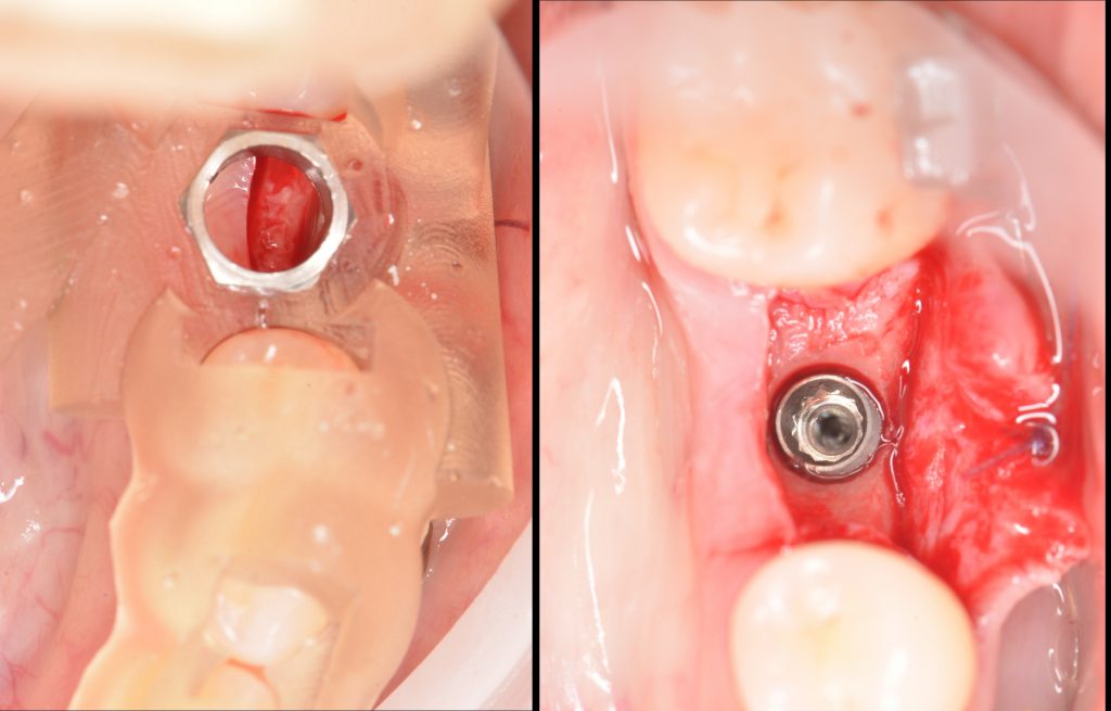 Case study: Implant planning for missing 36 (Universal 19) 9