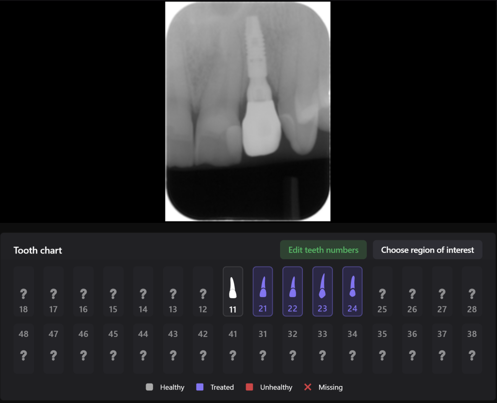 Aesthetic zone implant plan 11