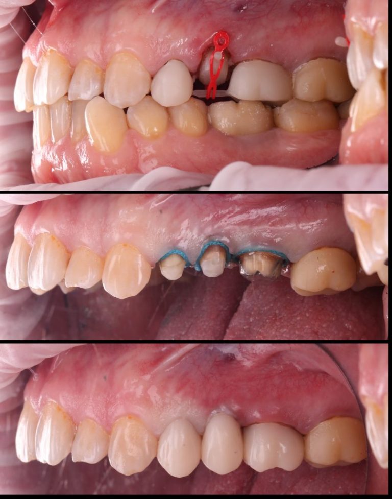 Case study - orthodontic treatment plan for tooth extrusion