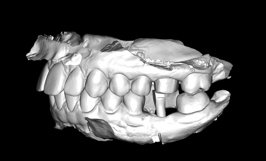 Fallstudie: Implantatplanung für fehlenden Zahn 36 (Universal 19) 13