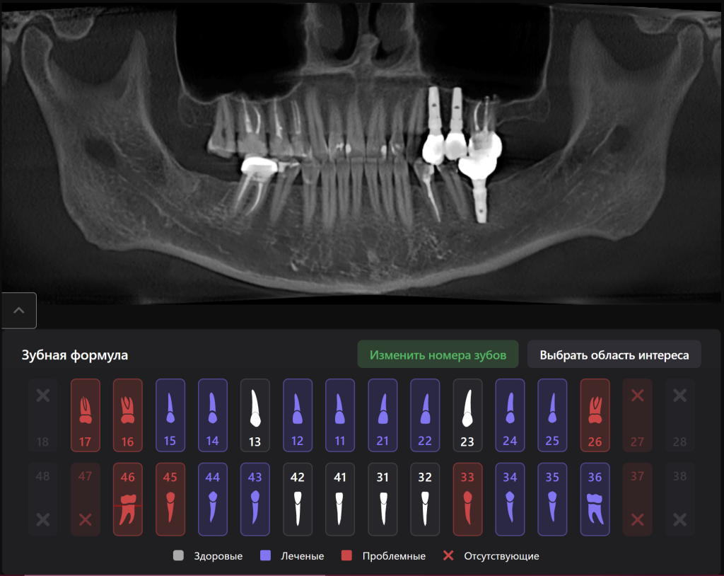 Планирование имплантации с помощью модулей Diagnocat 17