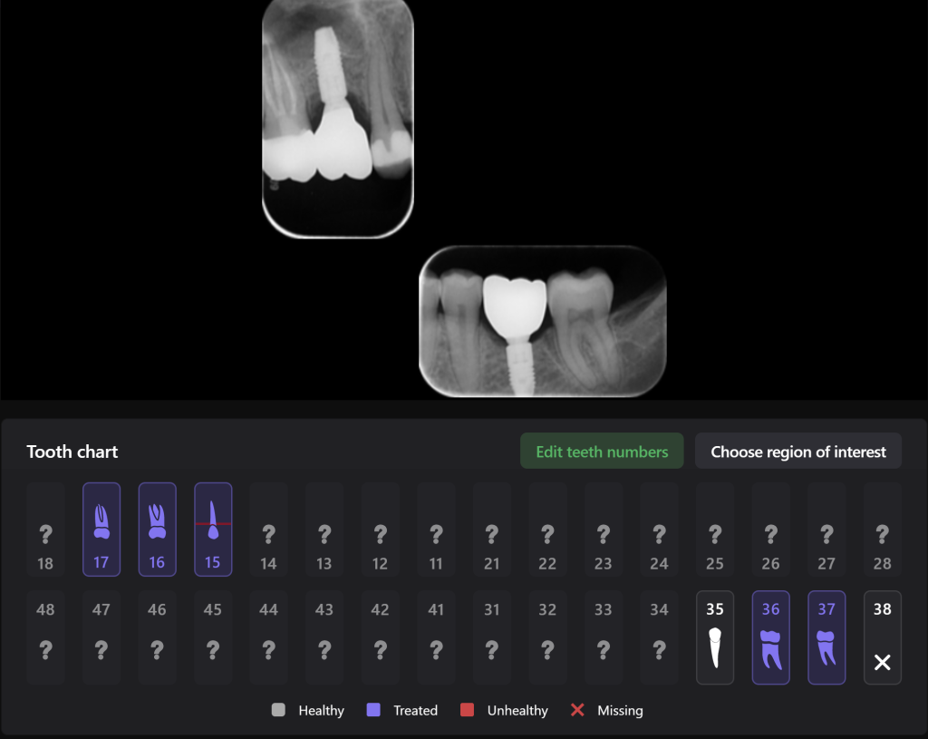 Case study: Implant planning for missing 36 (Universal 19) 17