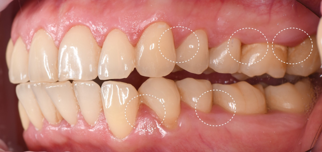 Timely periodontal screening with Diagnocat - the key to successful treatment result 1