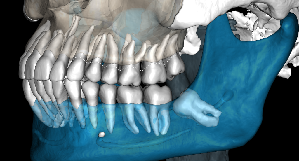 Timely periodontal screening with Diagnocat - the key to successful treatment result 3