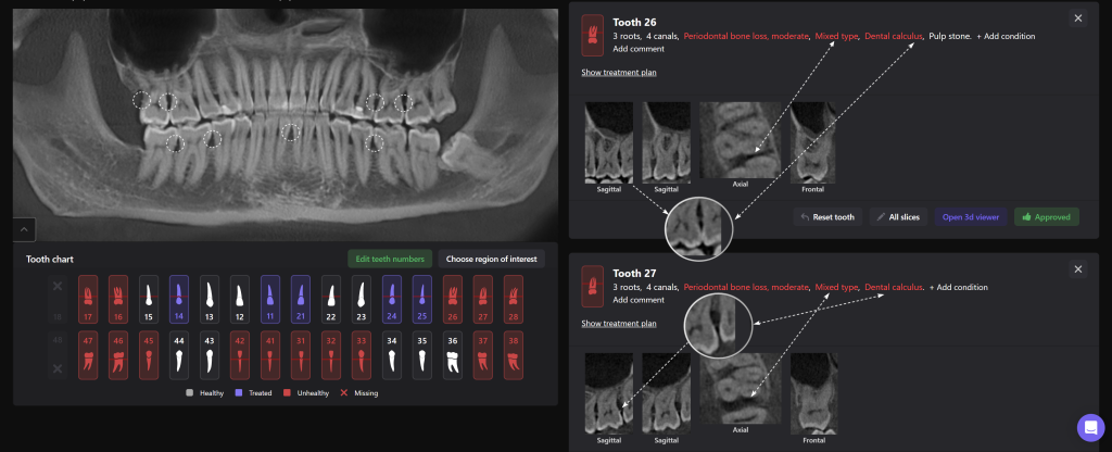 Timely periodontal screening with Diagnocat - the key to successful treatment result 5