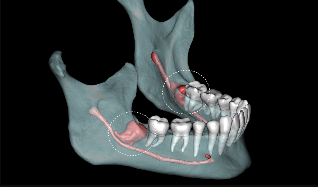 Third molar impaction - additional methods of analysis and extraction planning 1