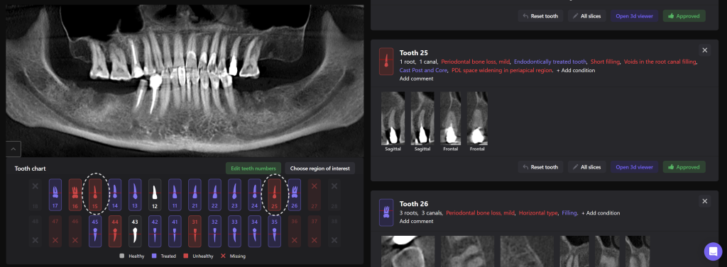 Simple Implant planning using the Diagnocat STL Module 1