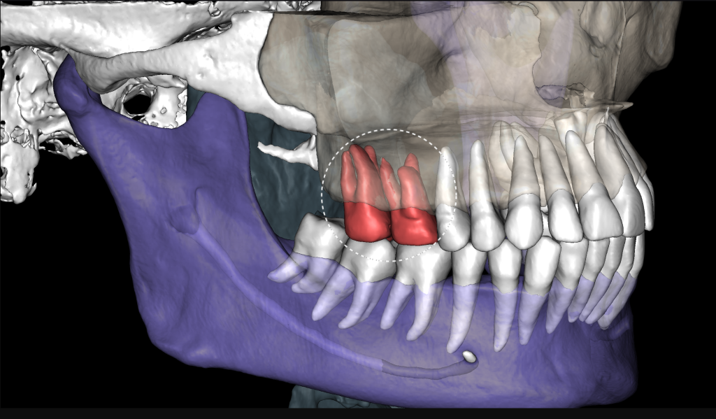 Odontogenic sinusitis associated with periapical lesion 1