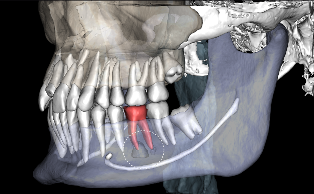 Diagnose häufiger endodontischer Komplikationen mit Diagnocat 1