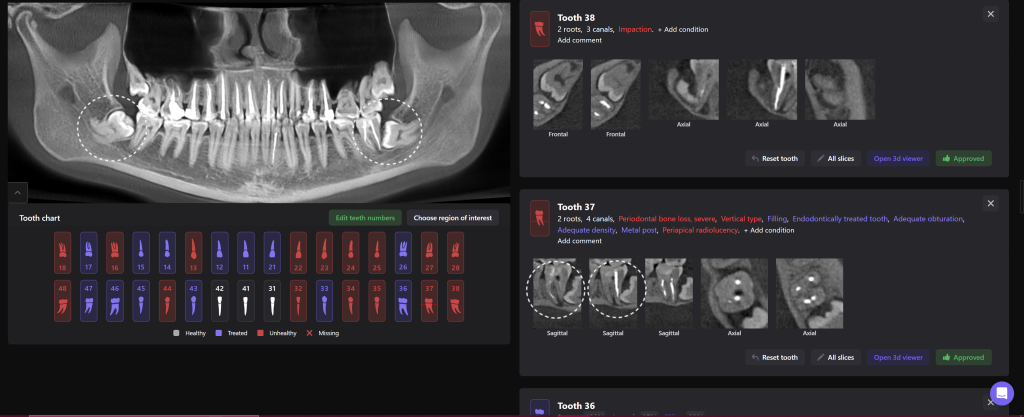 Third molar impaction - additional methods of analysis and extraction planning 3