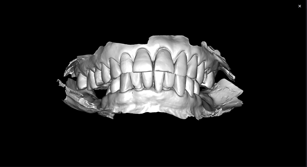 Simple Implant planning using the Diagnocat STL Module 3