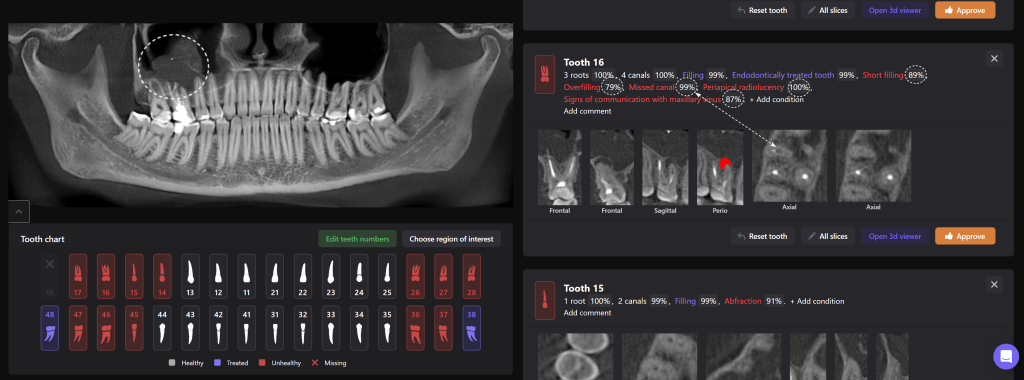 Odontogenic sinusitis associated with periapical lesion 3