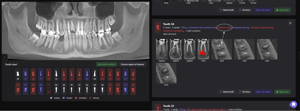 Diagnosis of frequent endodontic complications with Diagnocat 3