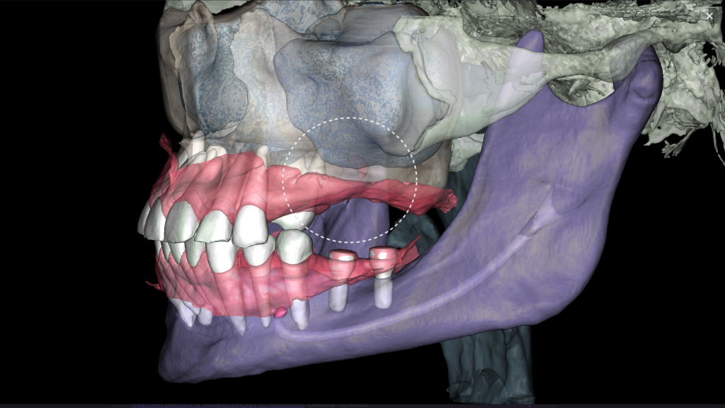 Implant planning together with the Diagnocat STL module 5