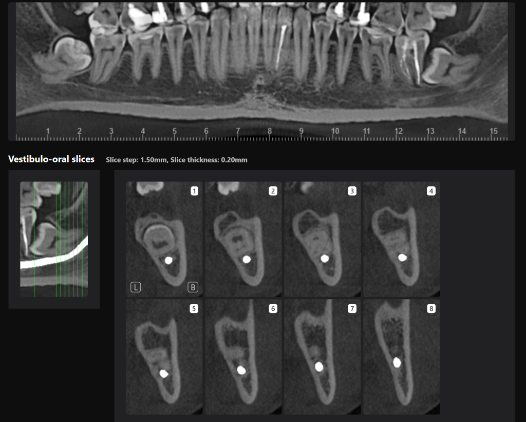 Third molar impaction - additional methods of analysis and extraction planning 5