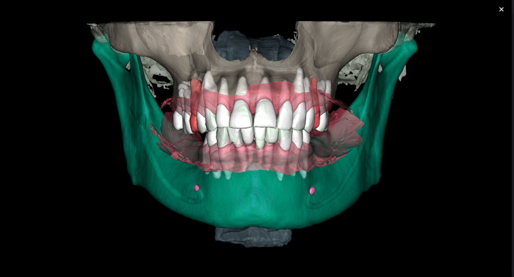 Simple Implant planning using the Diagnocat STL Module 5