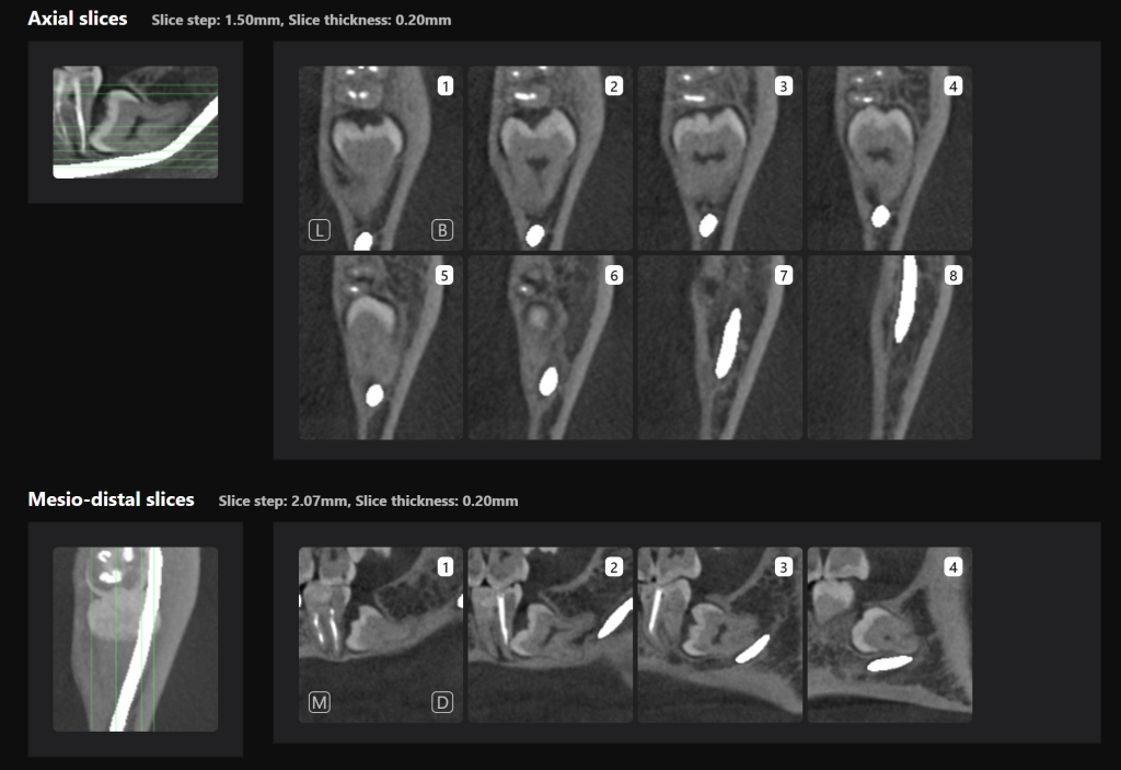 Third molar impaction - additional methods of analysis and extraction planning 7