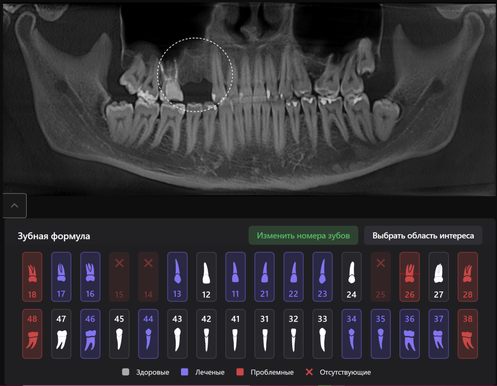 Планирование имплантации в области премоляров с использованием Diagnocat 1