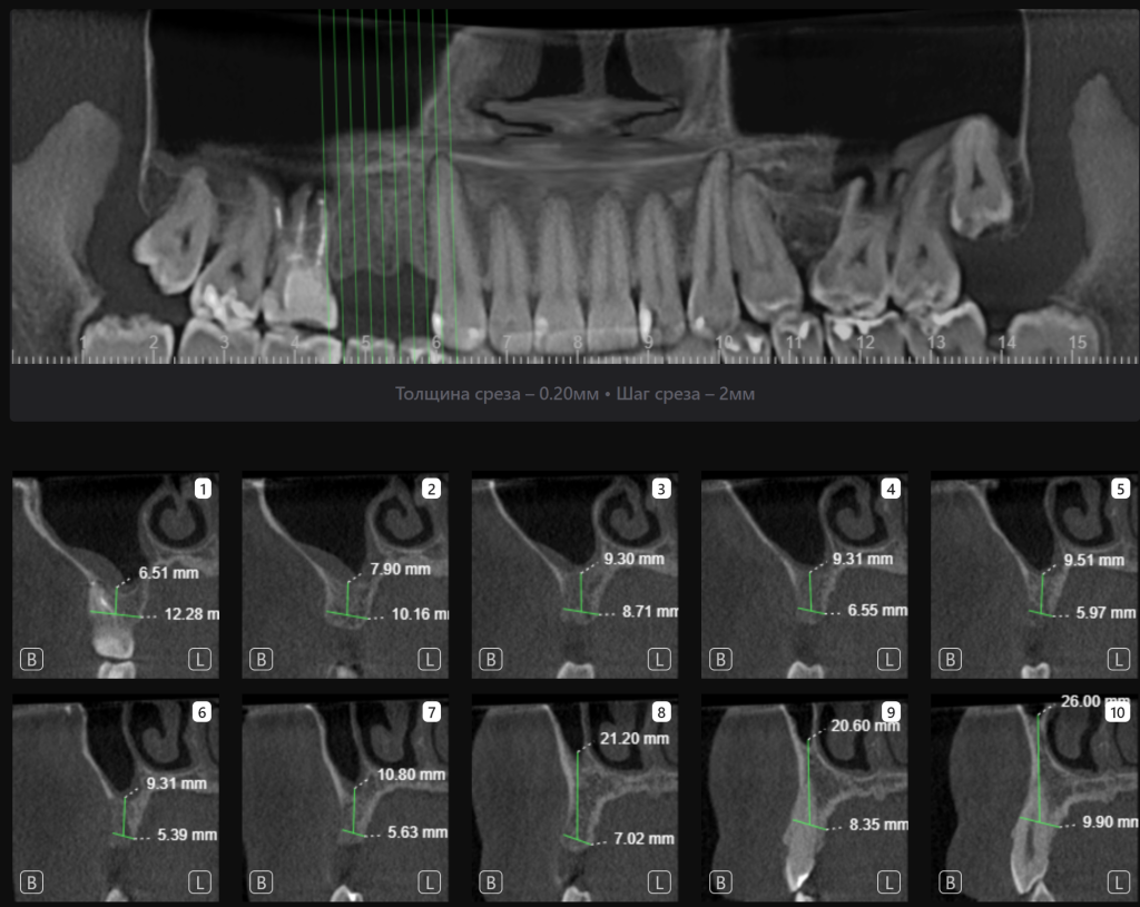 Планирование имплантации в области премоляров с использованием Diagnocat 3
