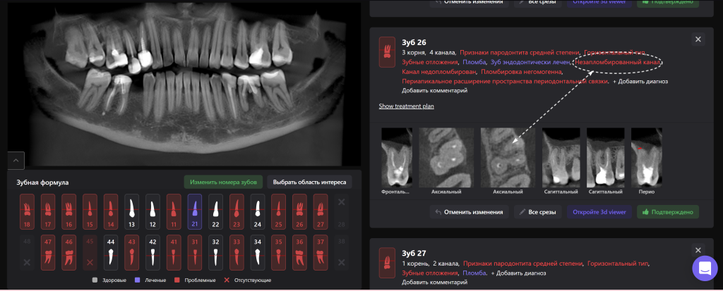 Изучите морфологию и анатомию корневых каналов с помощью Diagnocat 3