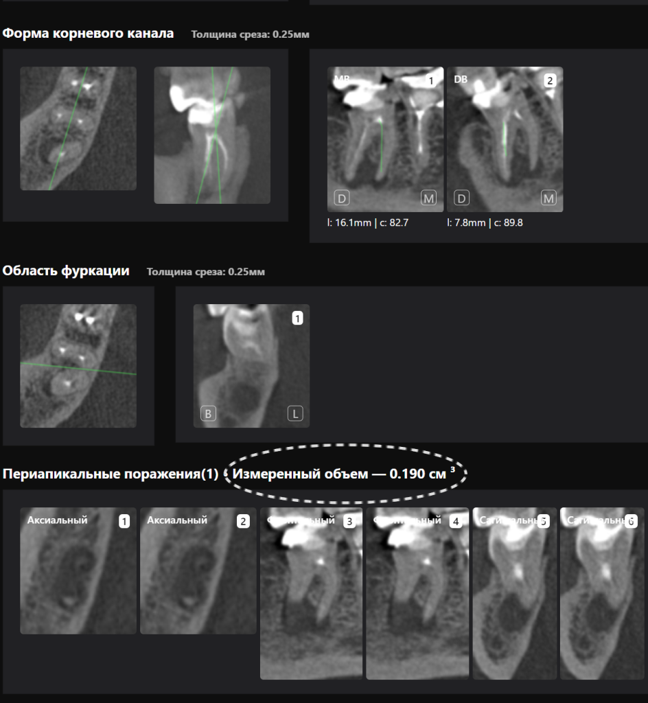 Оценка качества эндодонтического лечения с помощью Diagnocat 5