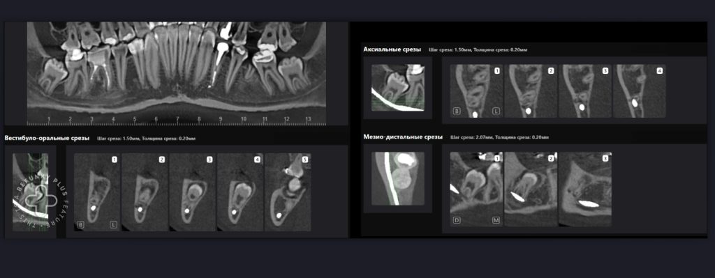 Планирование удаления третьего моляра с помощью Diagnocat 5