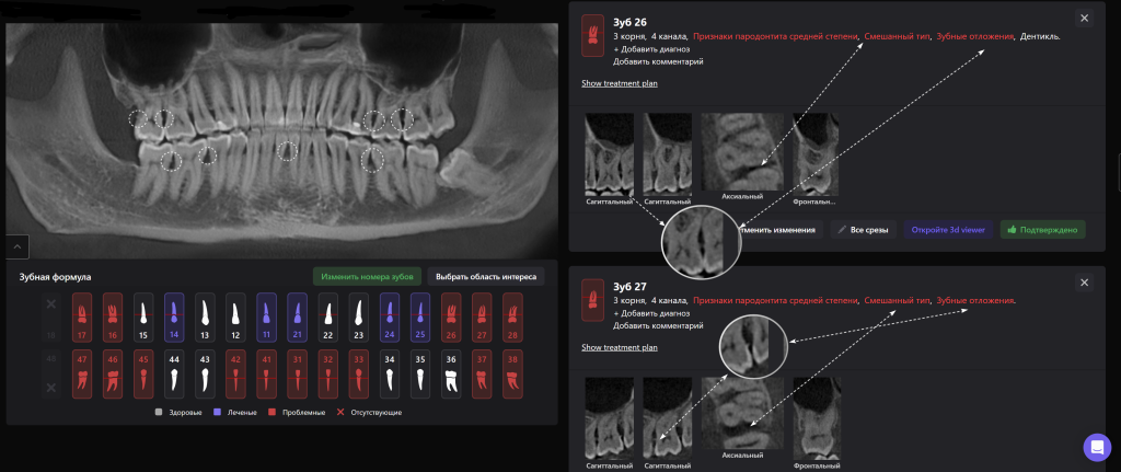 Своевременный пародонтологический скриннинг с помощью Diagnocat - залог успешного результата лечения 5