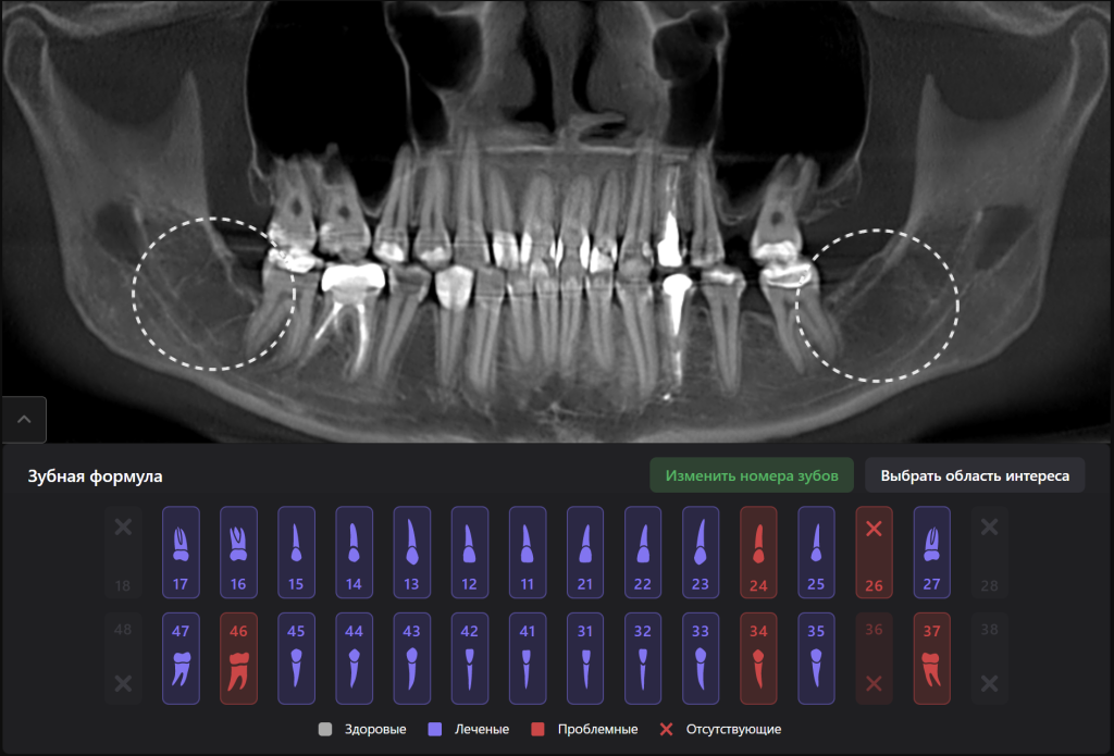 Планирование удаления третьего моляра с помощью Diagnocat 7