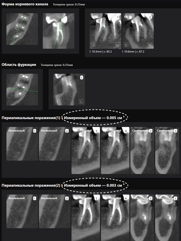 Оценка качества эндодонтического лечения с помощью Diagnocat 11