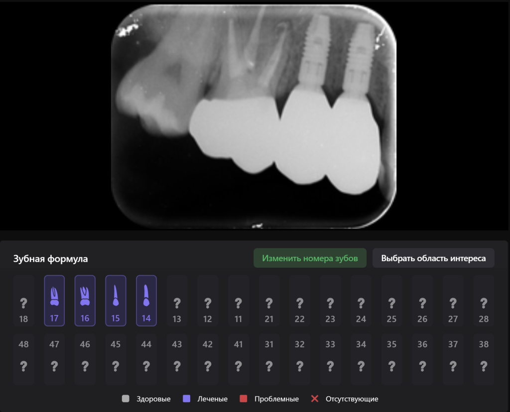 Планирование имплантации в области премоляров с использованием Diagnocat 15